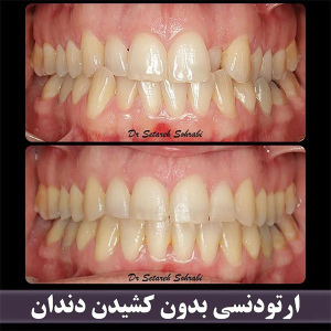 ارتودنسی-دندان-262