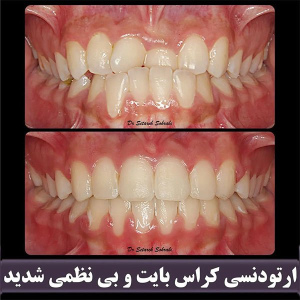 ارتودنسی-دندان-275
