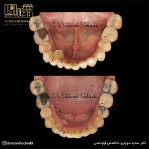 ارتودنسی-دندان-277