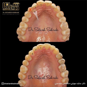ارتودنسی-دندان-278
