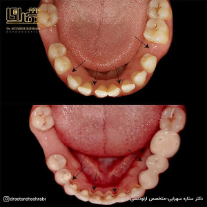 ارتودنسی-دندان-280