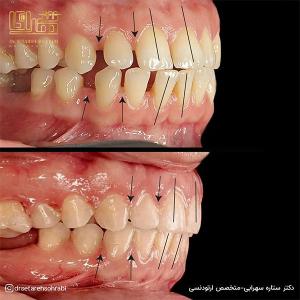 ارتودنسی-دندان-281