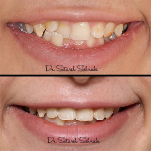 ارتودنسی-دندان-282