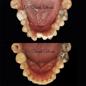 ارتودنسی-دندان-285