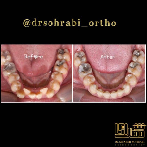 ارتودنسی-دندان-3