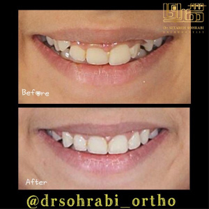 ارتودنسی-دندان-4