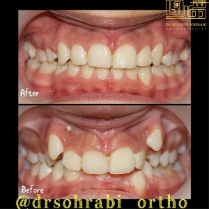 ارتودنسی-دندان-5