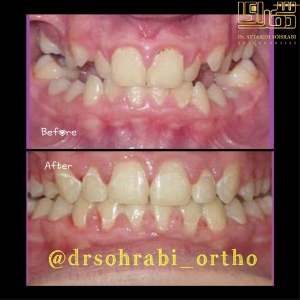 ارتودنسی-دندان-6