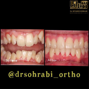 ارتودنسی-دندان-7