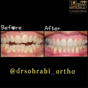 ارتودنسی-دندان-8