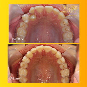 ارتودنسی-دندان-9