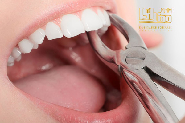 کشیدن دندان در ارتودنسی - دکتر سهرابی