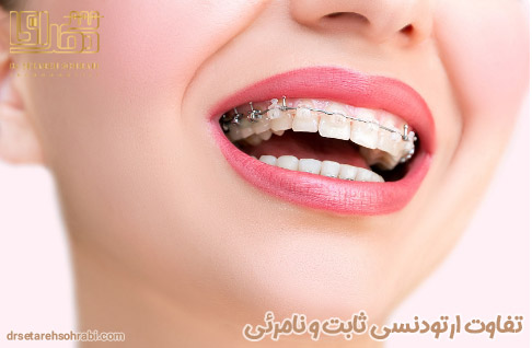 تفاوت ارتودنسی ثابت و نامرئی