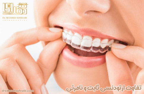 تفاوت ارتودنسی ثابت و نامرئی