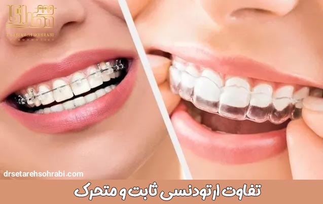 تفاوت ارتودنسی ثابت و متحرک