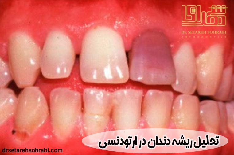 تحلیل ریشه دندان در ارتودنسی