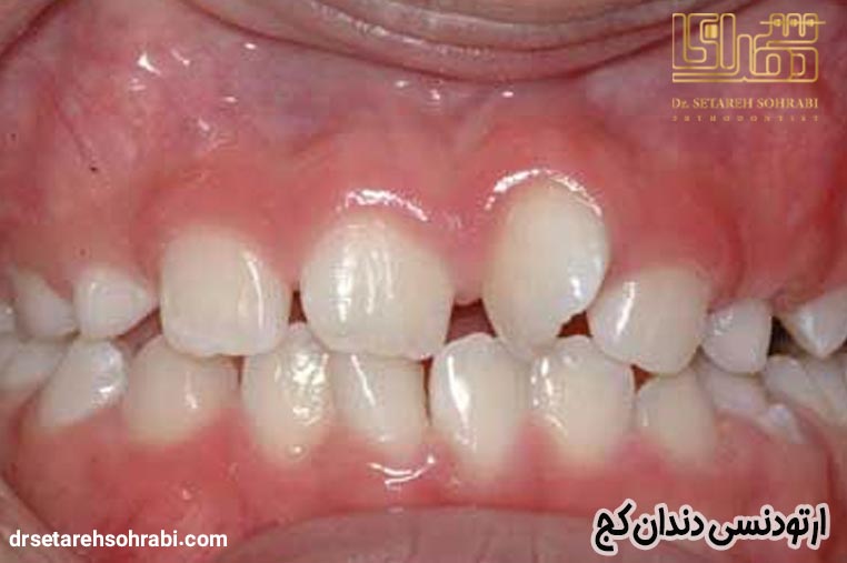ارتودنسی دندان کج