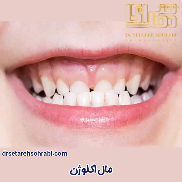 مال اکلوژن