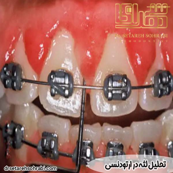 تحلیل لثه در ارتودنسی