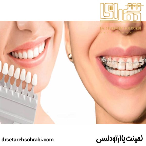 Bonding or orthodontics