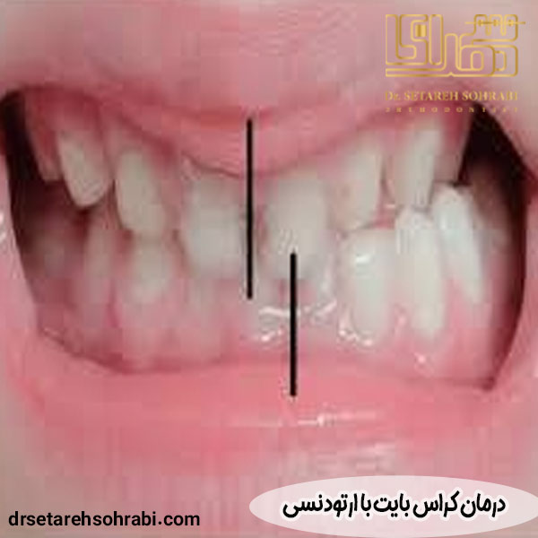درمان کراس بایت با ارتودنسی