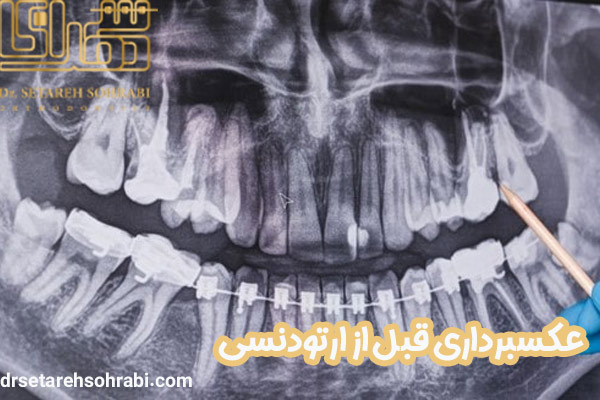 عکسبرداری قبل از ارتودنسی - دکتر ستاره سهرابی - drsetarehsohrabi.com