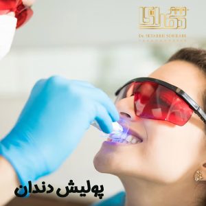 پولیش دندان - دکتر ستاره سهرابی - drsetarehsohrabi.com