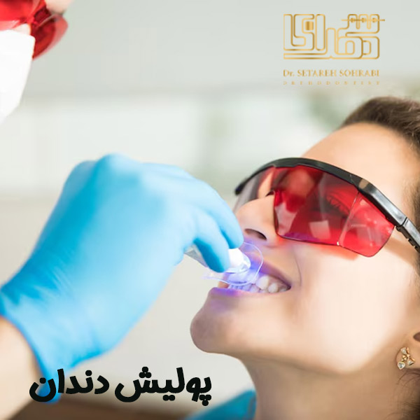 پولیش دندان - دکتر ستاره سهرابی - drsetarehsohrabi.com