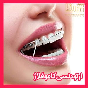 ارتودنسی کاموفلاژ - دکتر ستاره سهرابی - drsetarehsohrabi.com