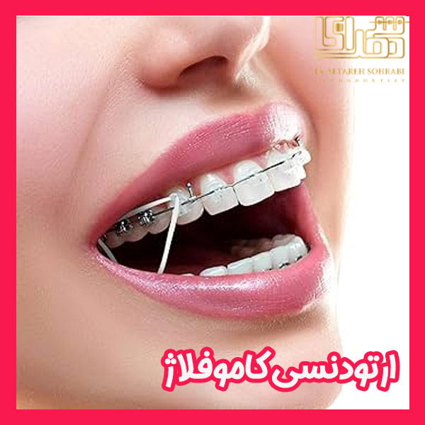 ارتودنسی کاموفلاژ - دکتر ستاره سهرابی - drsetarehsohrabi.com