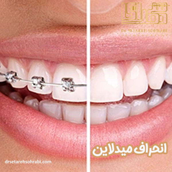 انحراف میدلاین دندان - دکتر ستاره سهرابی - drsetarehsohrabi.com