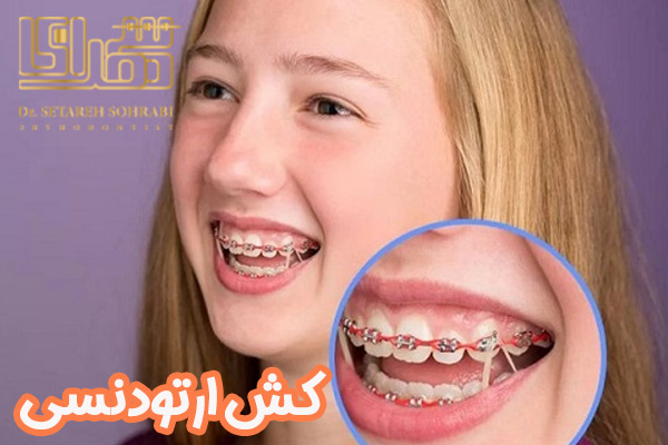 کش ارتودنسی - دکتر ستاره سهرابی - drsetarehsohrabi.com