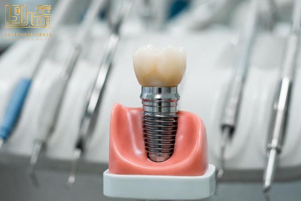 ایمپلنت دیجیتال چیست