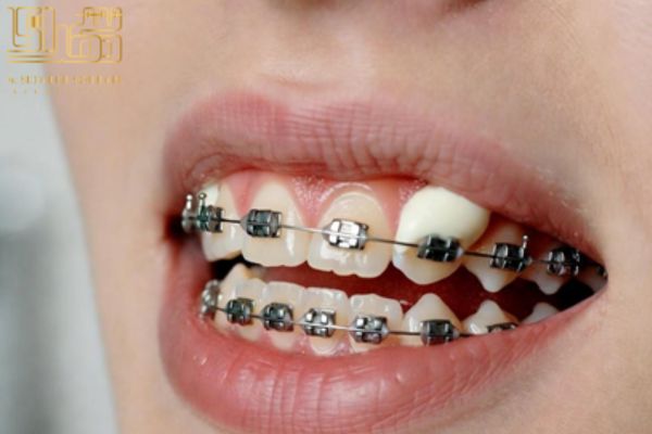 موم ارتودنسی