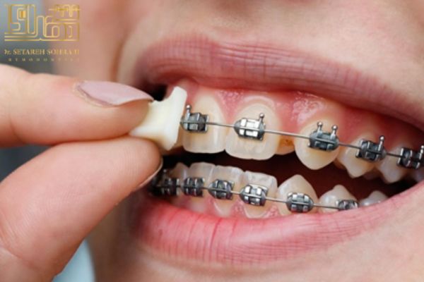 کاربرد موم ارتودنسی