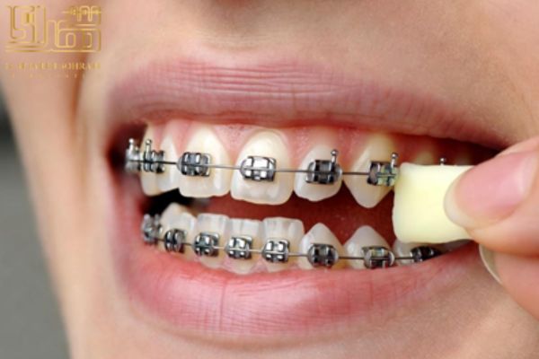 موم ارتودنسی کامل