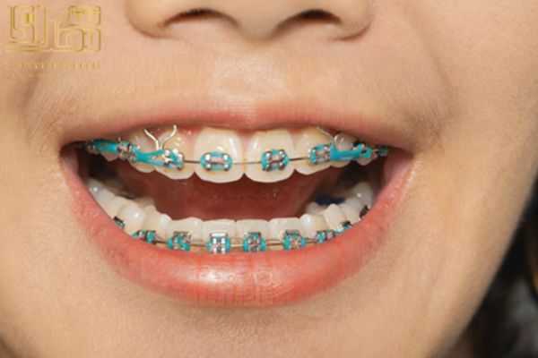 کش ارتودنسی روشن