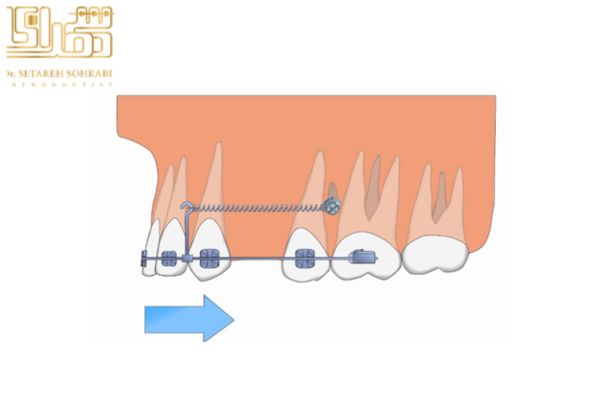 تصویربرداری و ارزیابی قبل از قرار دادن مینی اسکرو